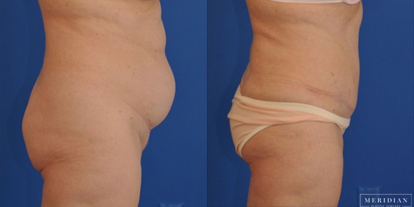 Tummy Tuck - Thumbnail 2