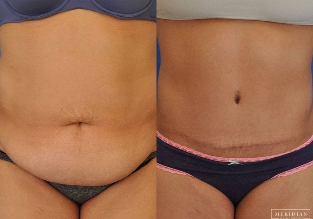 Tummy Tuck - Case 7800