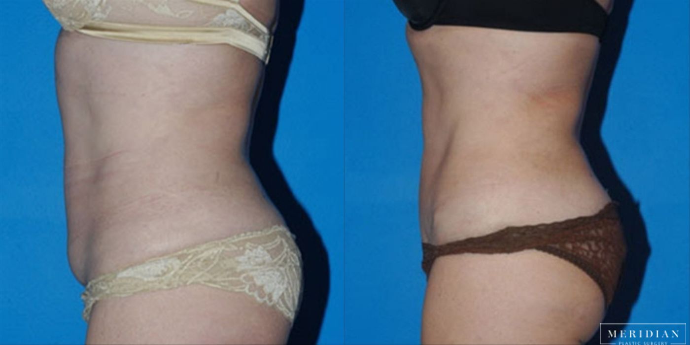 Tummy Tuck - Thumbnail 2