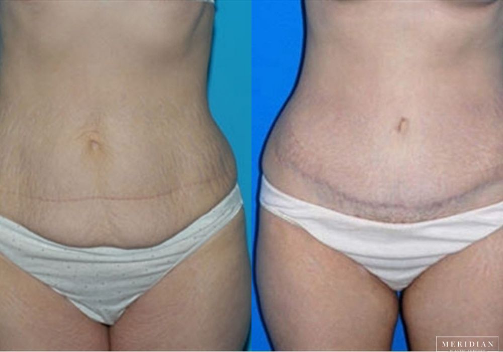 Tummy Tuck - Case 7999