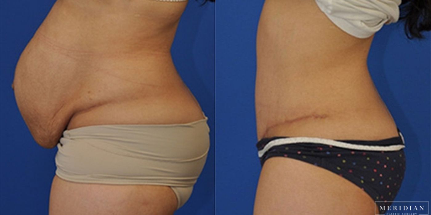 Tummy Tuck - Thumbnail 3