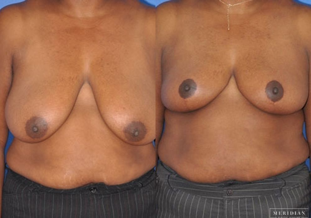 Breast Reduction - Case 7883