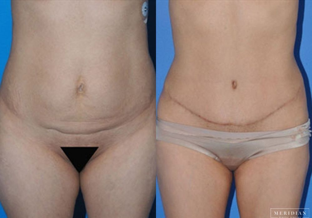 Body Contouring - Case 7966