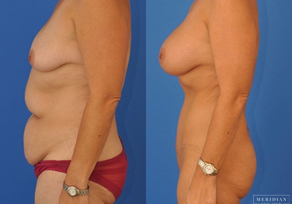 Tummy Tuck - Thumbnail 2