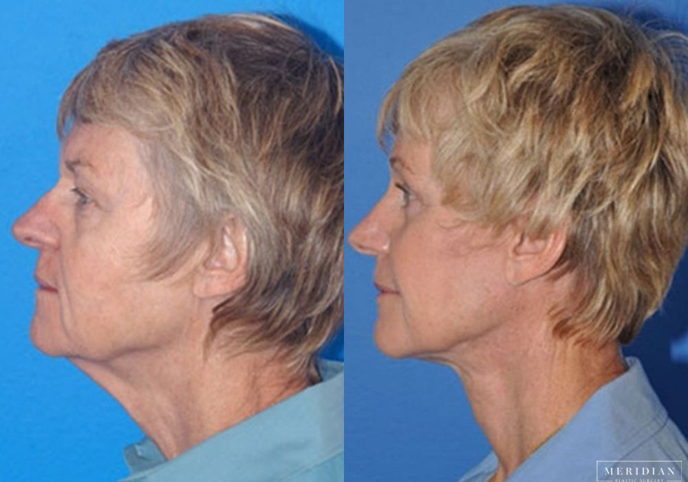 Brow Lift - Thumbnail 2