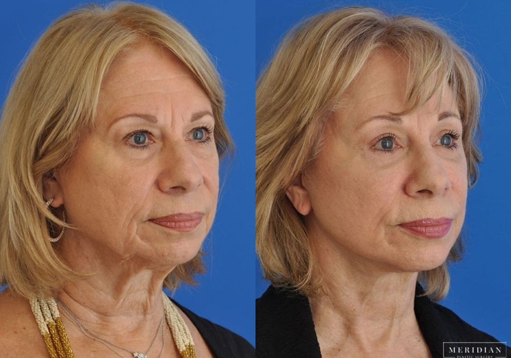 Neck Lift - Thumbnail 3
