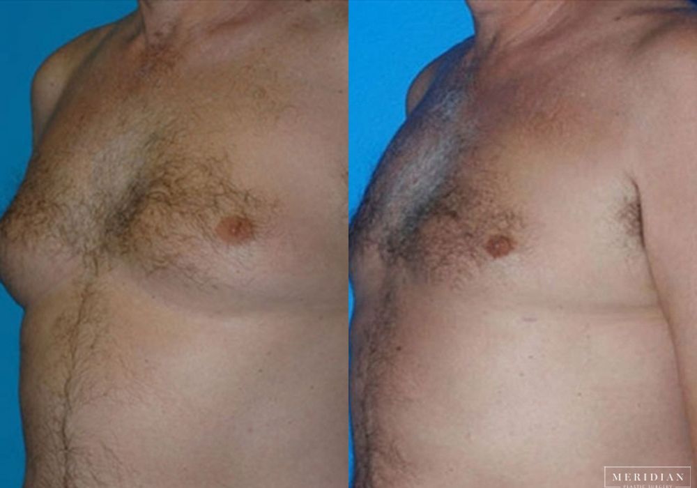 Gynecomastia - Case 7899