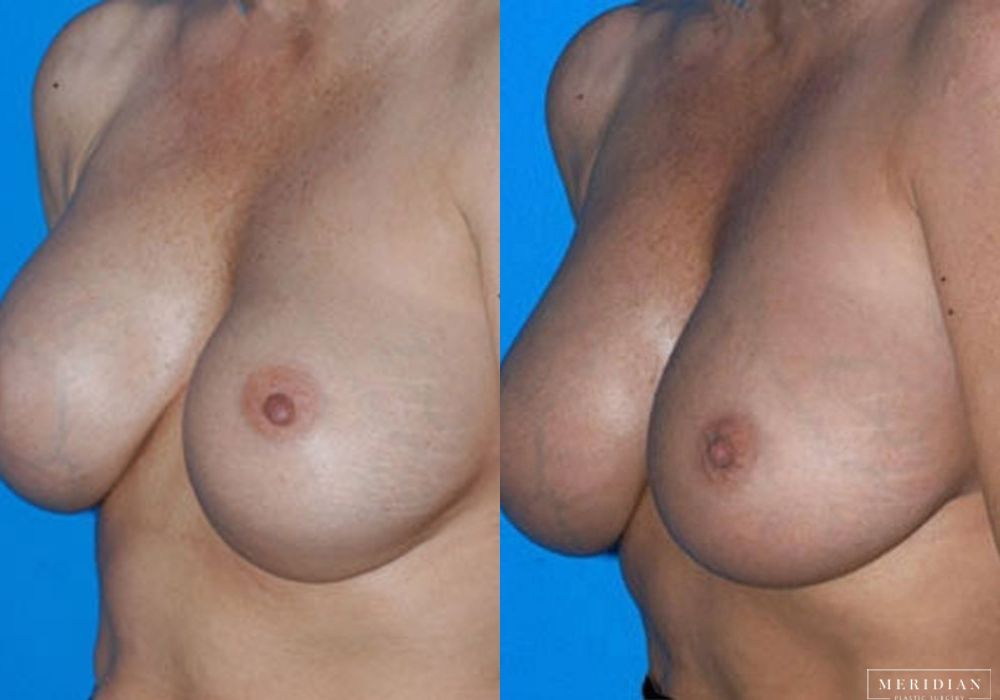 Breast Revision - Thumbnail 2