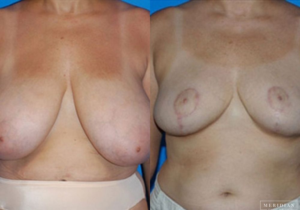 Breast Reduction - Case 7885