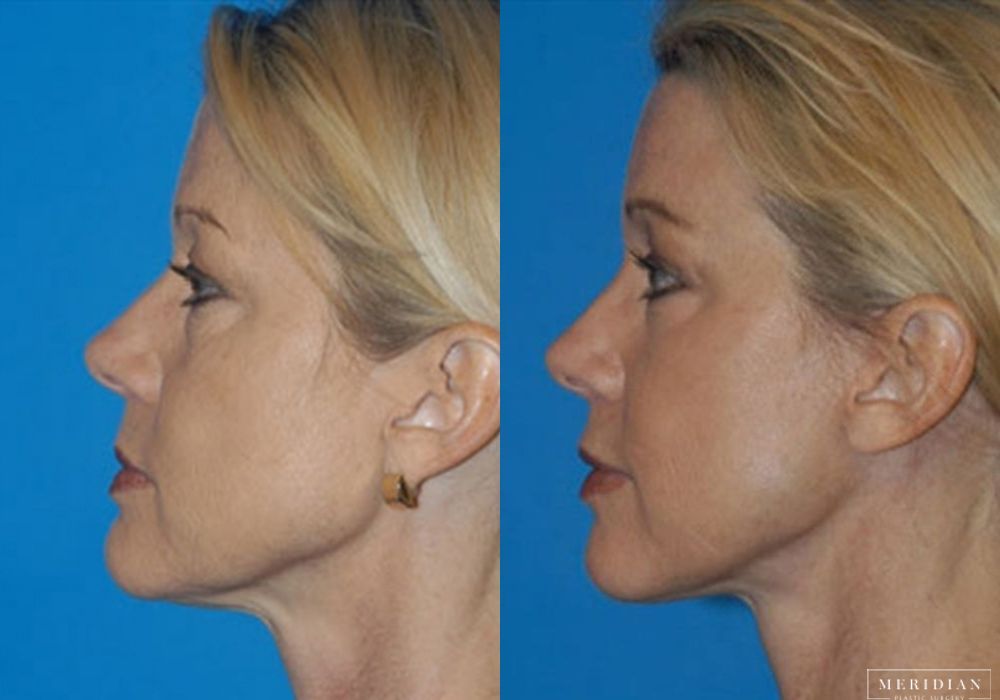 Facelift - Thumbnail 2