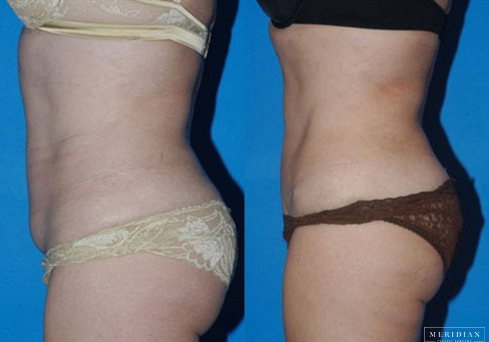 Tummy Tuck - Thumbnail 2