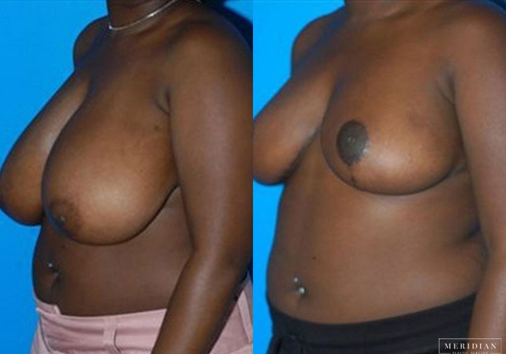 Breast Reduction - Thumbnail 2