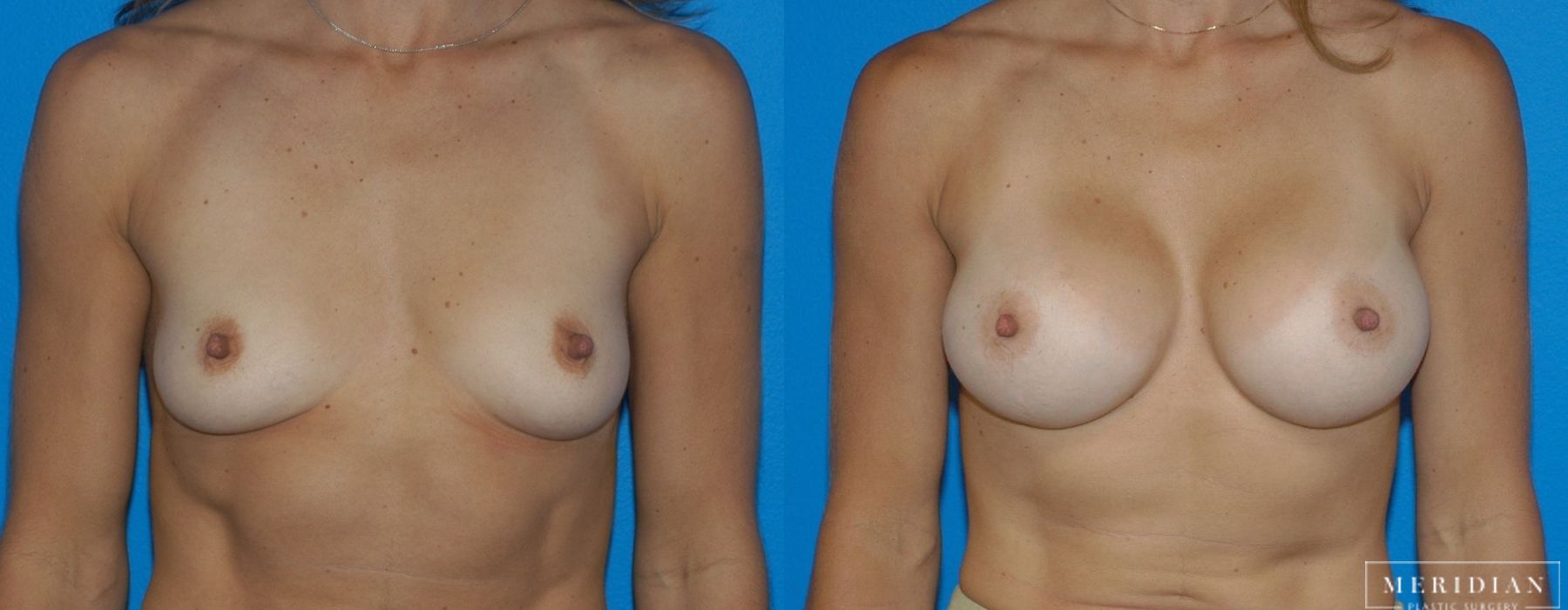 Breast Augmentation - Thumbnail 2
