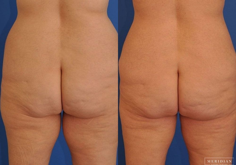 Body Contouring - Thumbnail 2