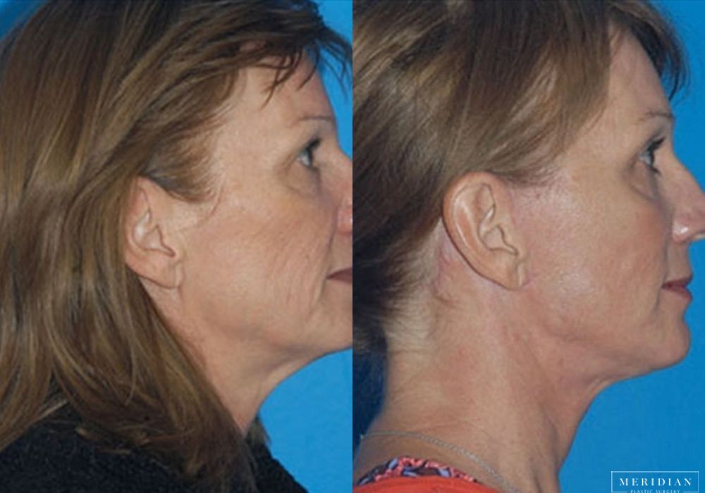 Brow Lift - Thumbnail 2