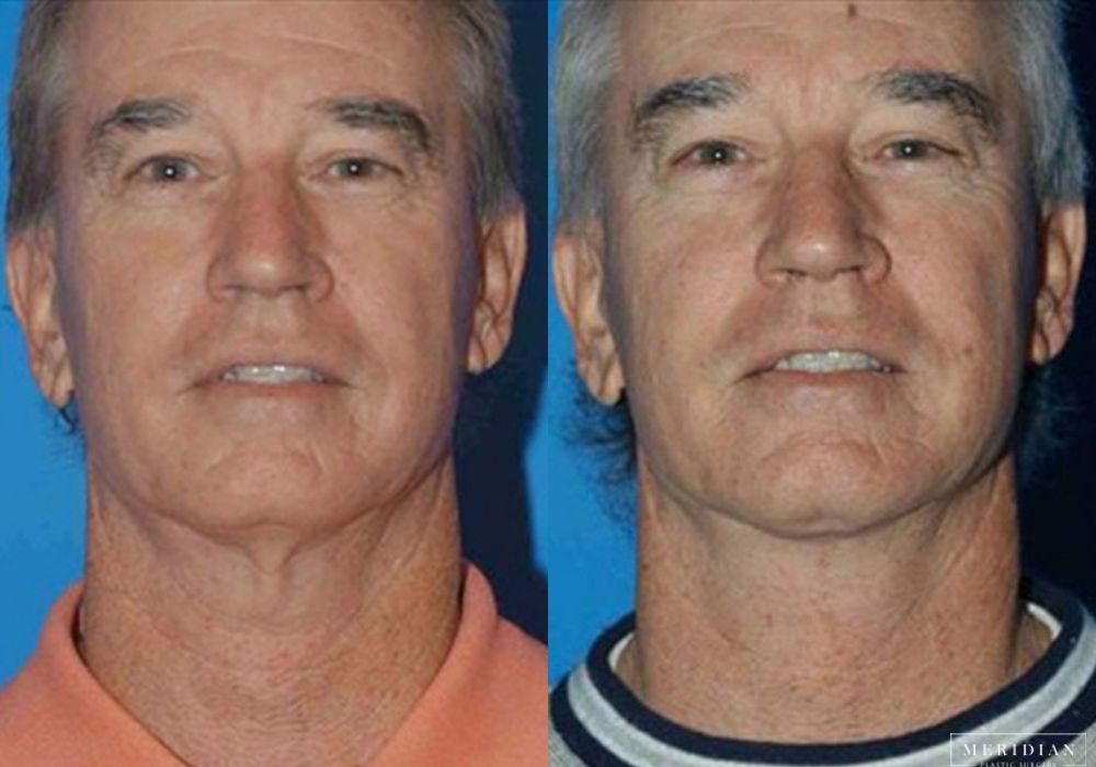 Neck Lift - Case 8128