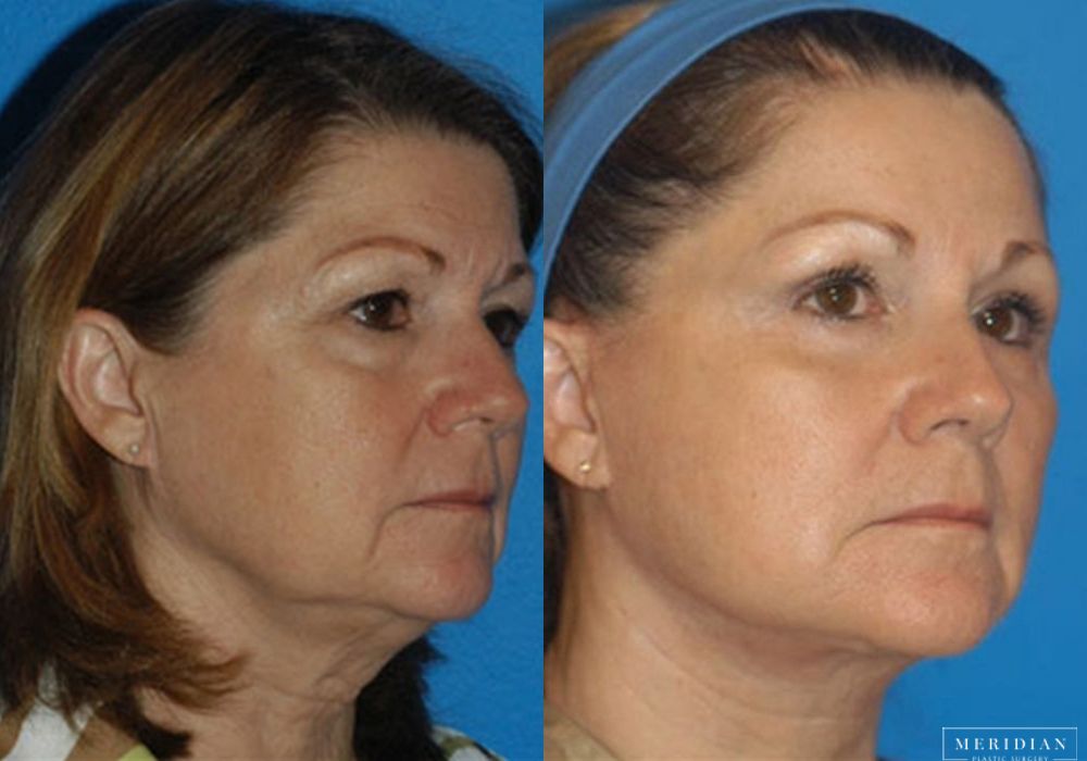 Eyelid Lift - Thumbnail 2