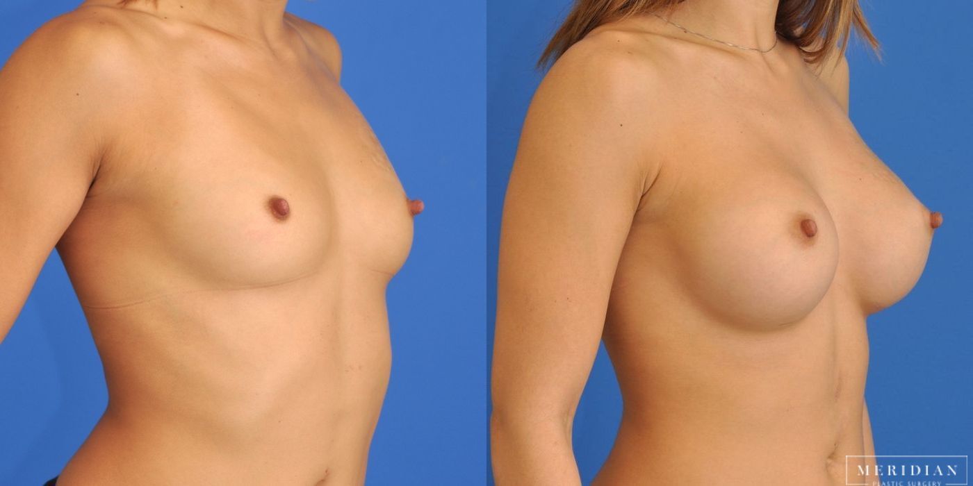 Breast Augmentation - Thumbnail 2