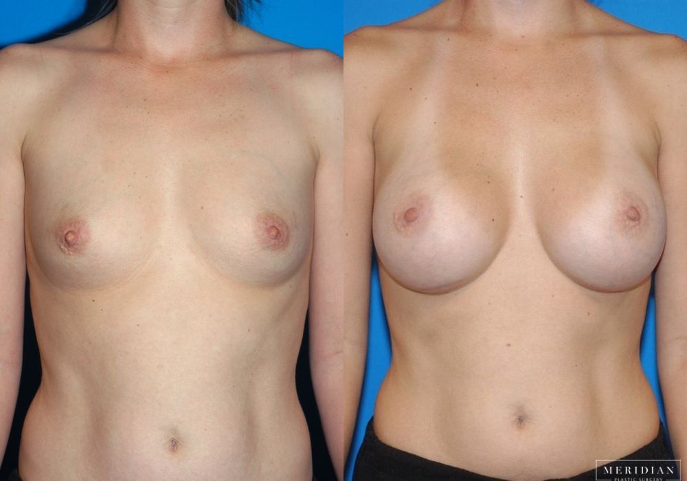 Breast Augmentation - Case 8053