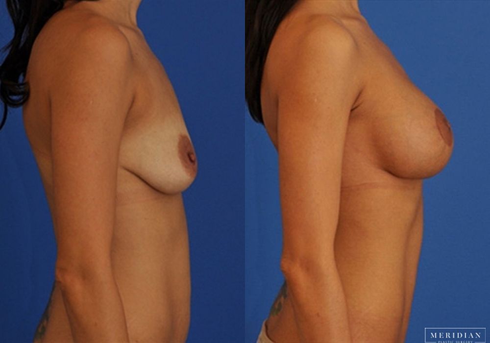 Breast Lift - Thumbnail 2