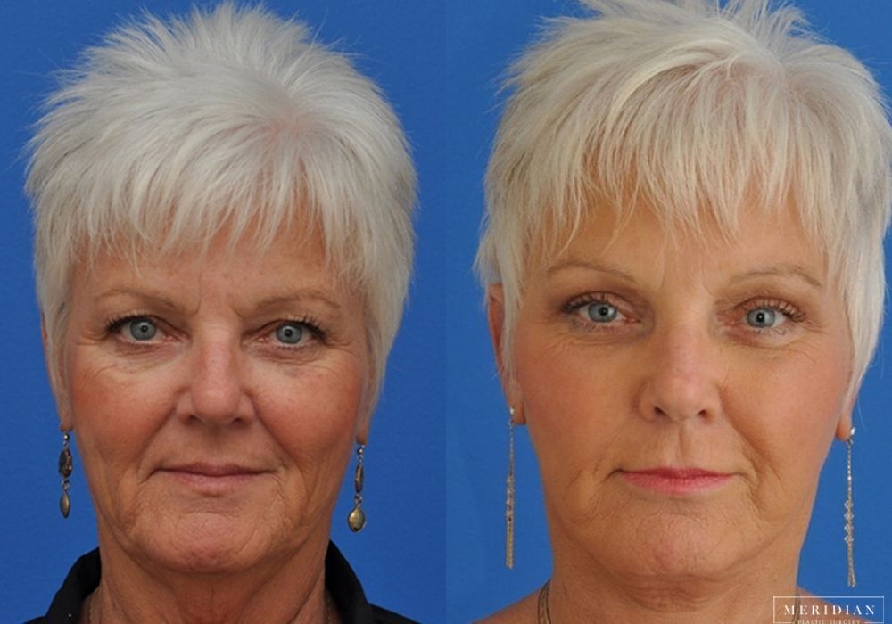 Facelift - Case 8124