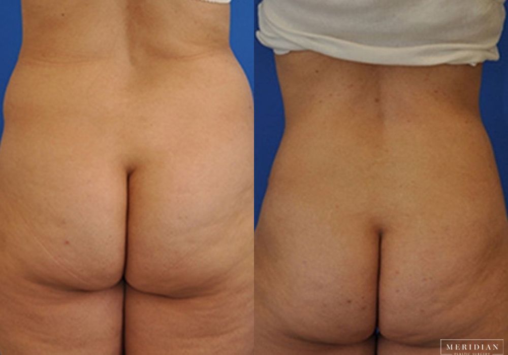 Tummy Tuck - Thumbnail 2