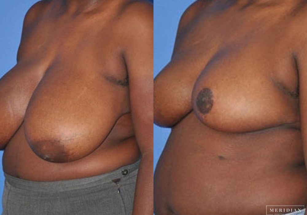 Breast Reduction - Thumbnail 2