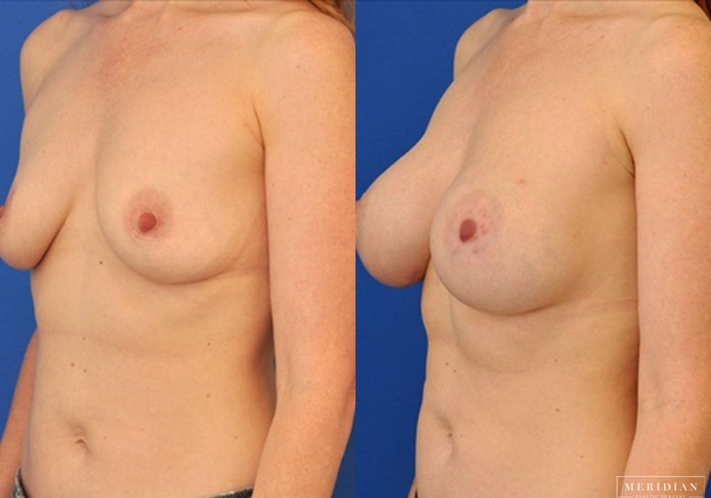 Breast Augmentation - Thumbnail 2