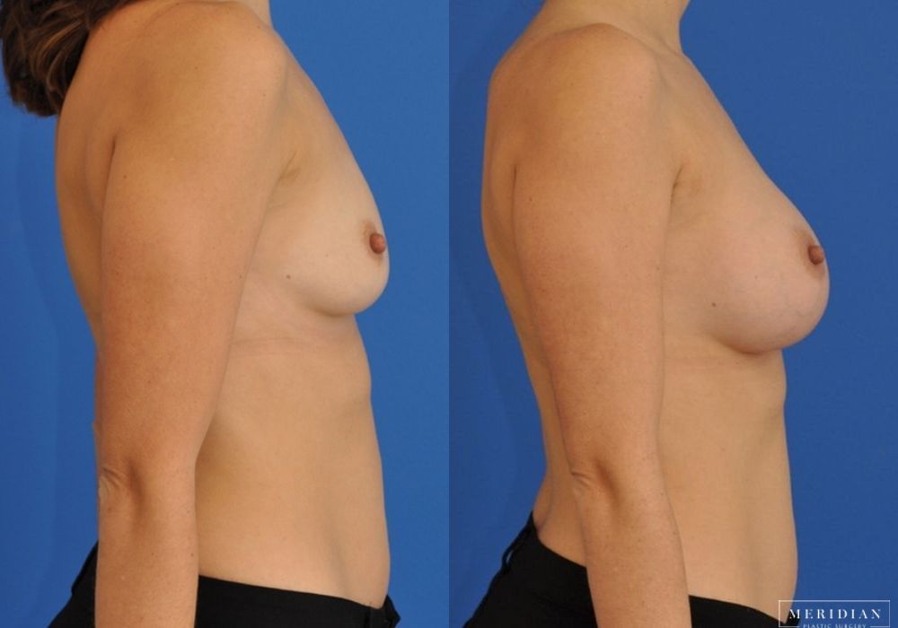 Breast Augmentation - Thumbnail 2