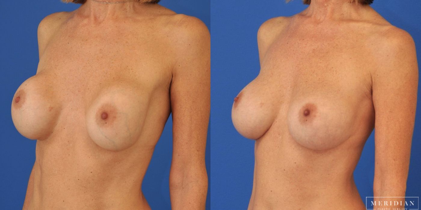 Breast Revision - Thumbnail 2