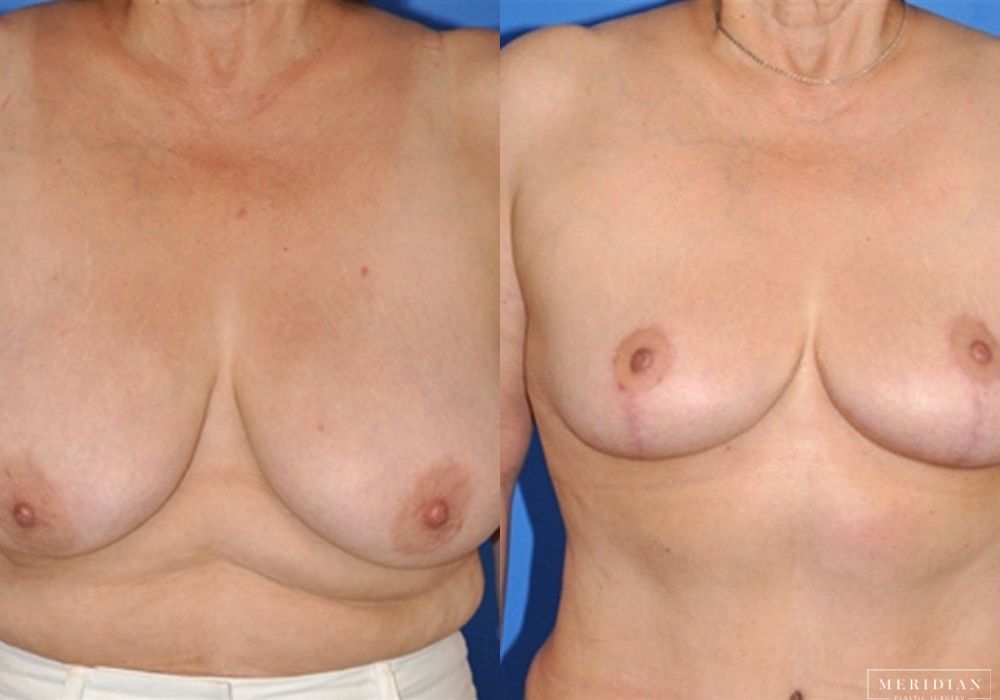 Breast Lift - Case 7875