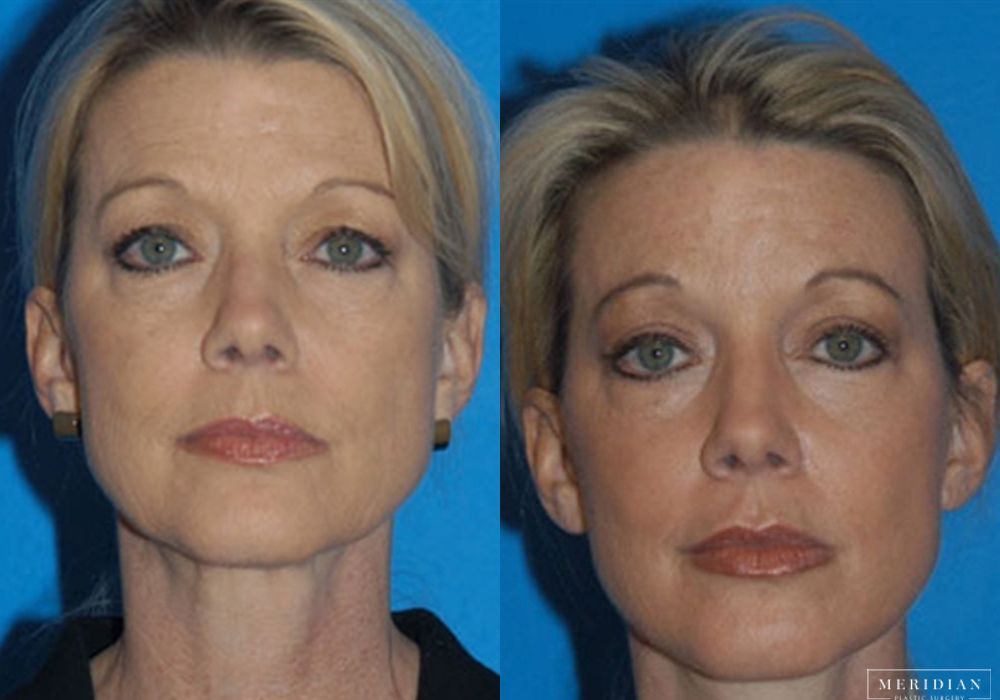 Injectables - Case 7953