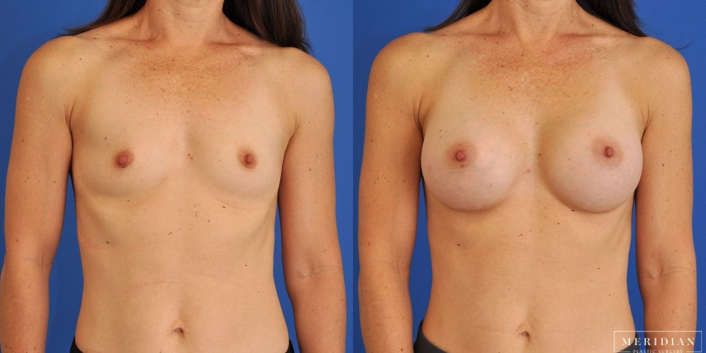 Breast Augmentation - Case 8015