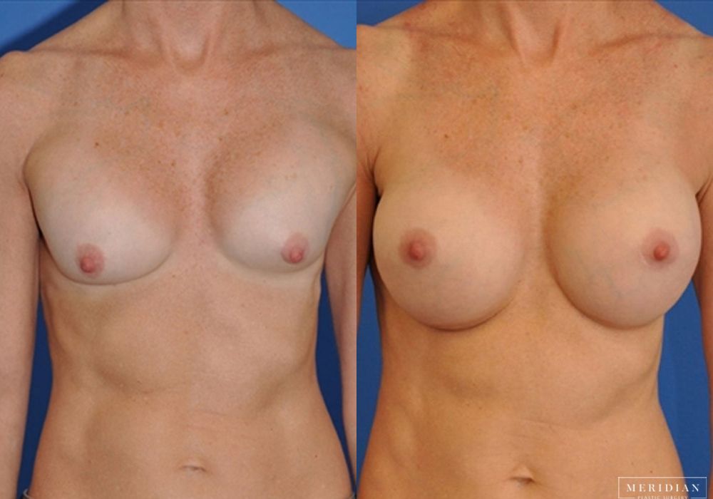 Before and after procedure result