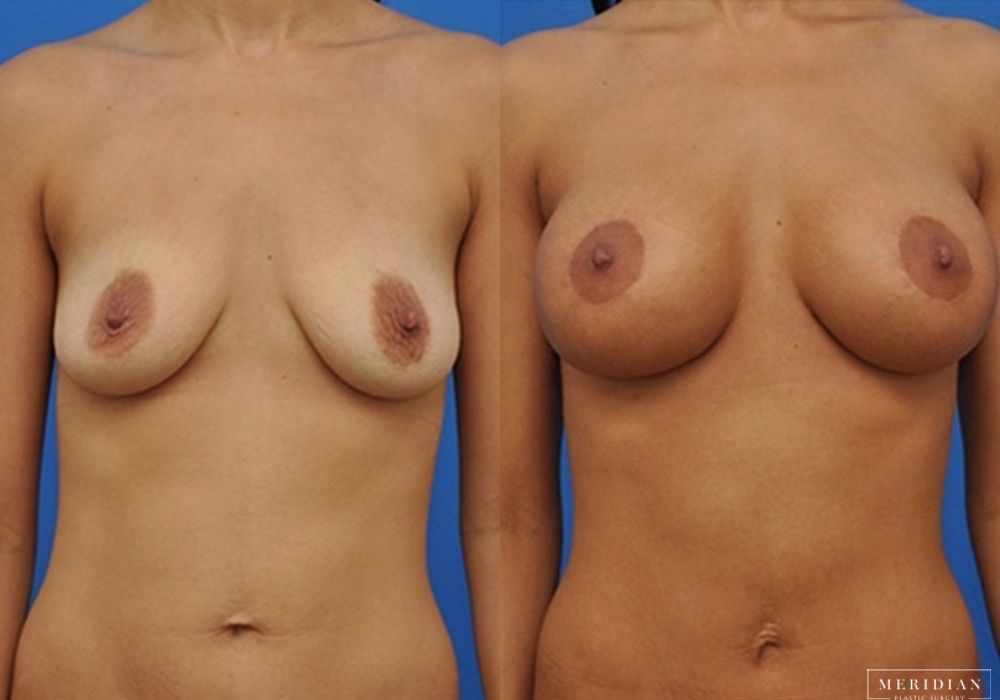 Breast Lift - Case 7863