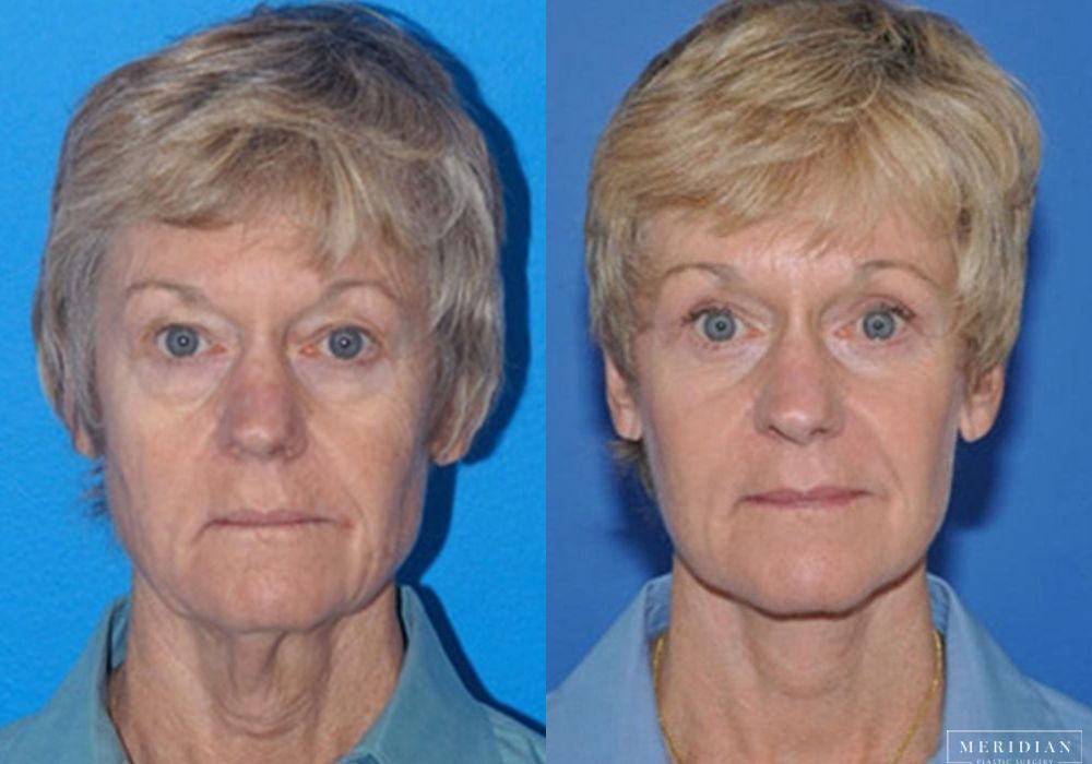 Brow Lift - Case 7910