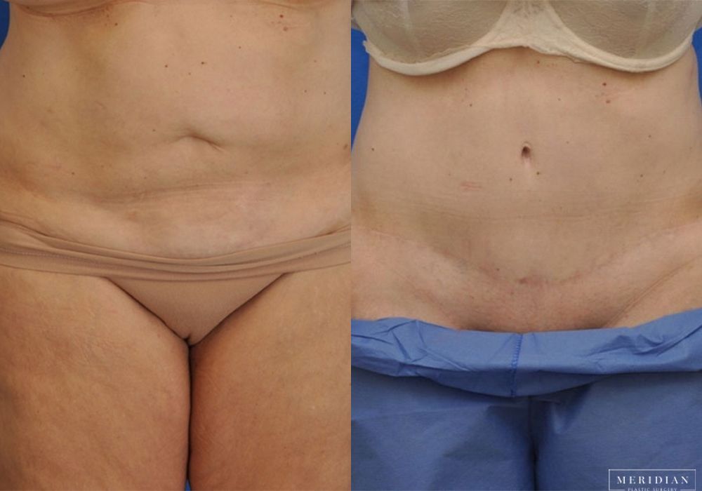 Tummy Tuck - Case 8002