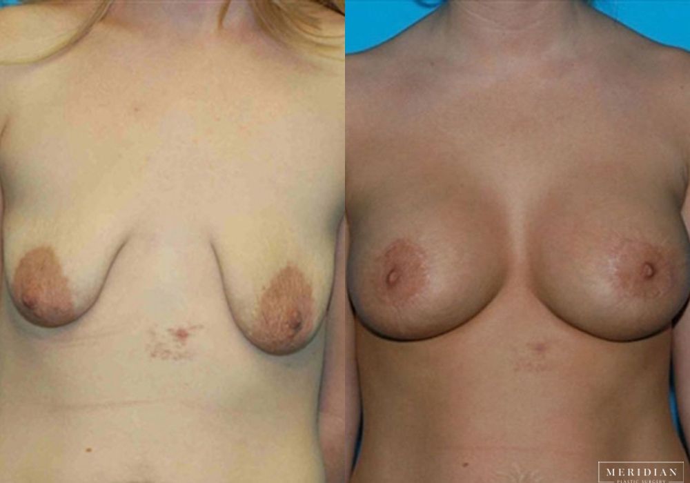 Breast Lift - Case 7870