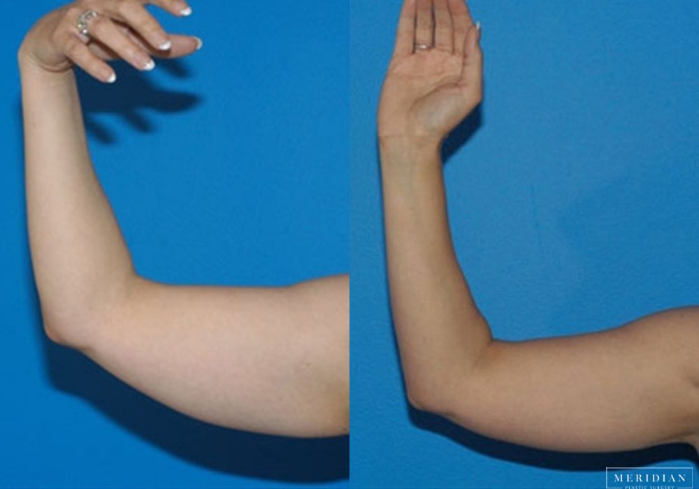 Body Contouring - Case 7976