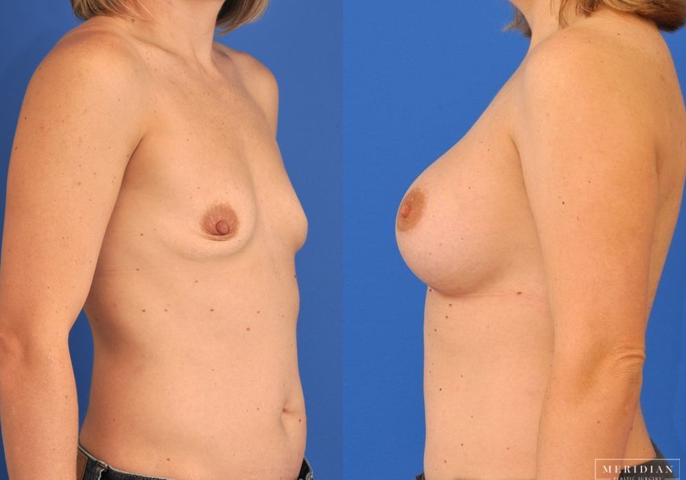 Breast Augmentation - Thumbnail 2
