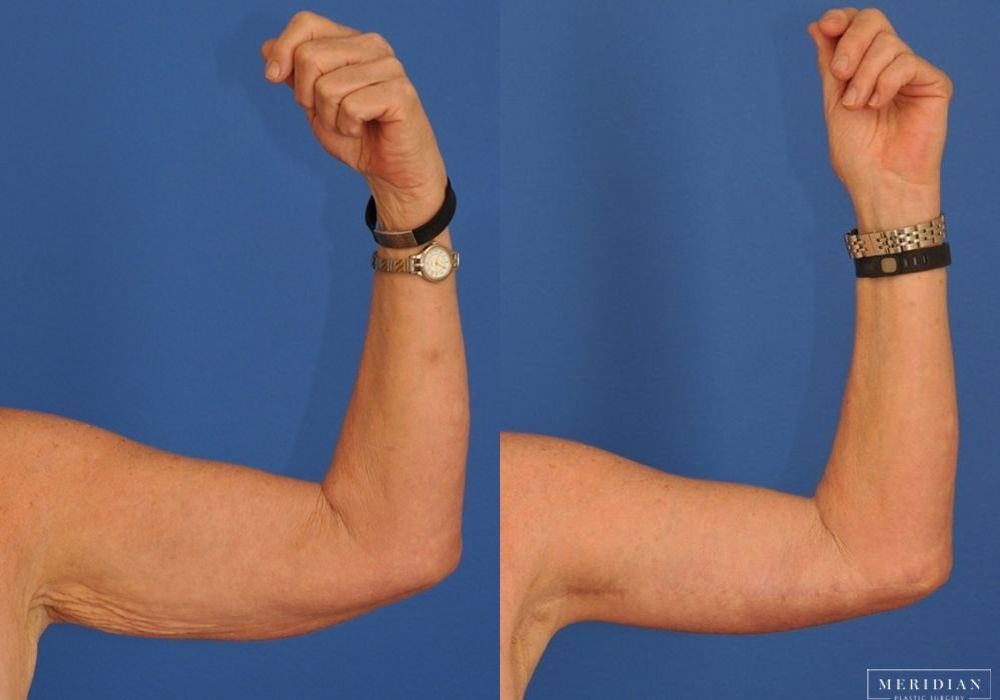 Arm Lift - Case 7756