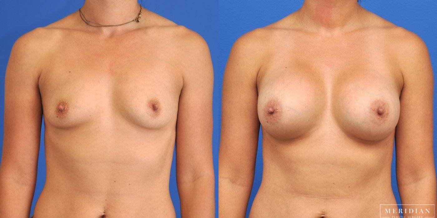 Breast Augmentation - Thumbnail 3