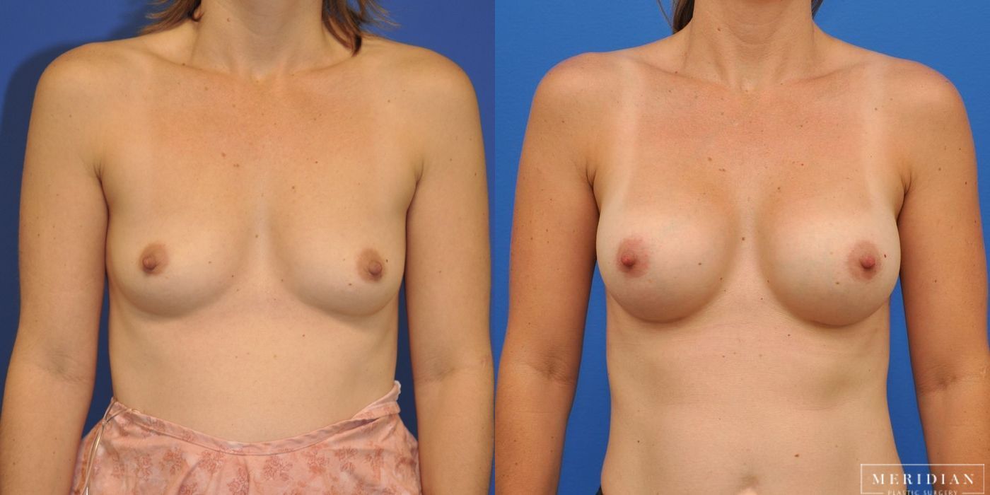 Breast Augmentation - Case 8027