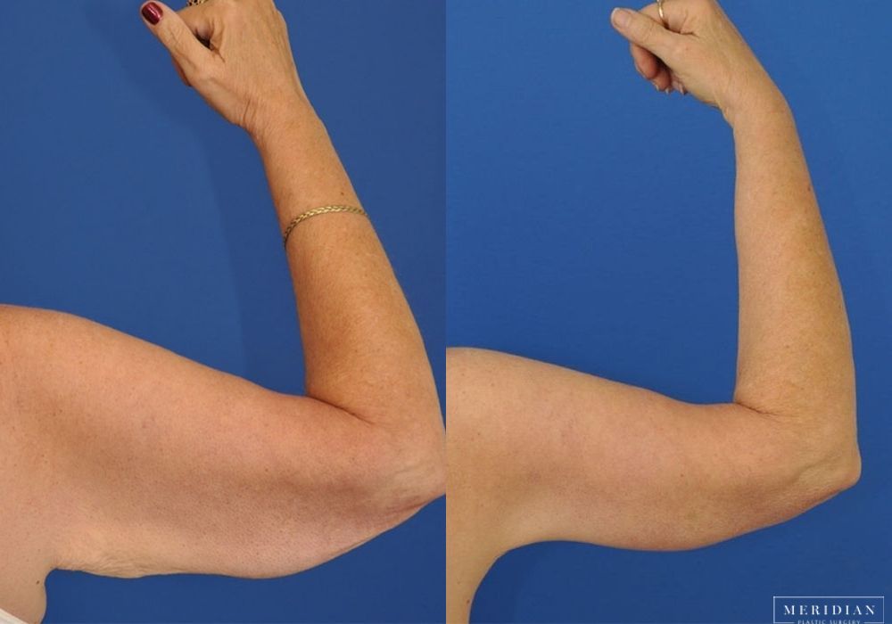 Body Contouring - Thumbnail 2