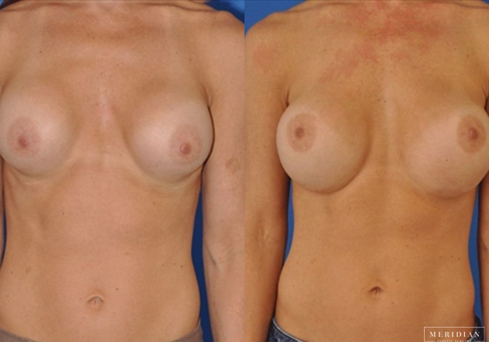 Breast Revision - Case 8085