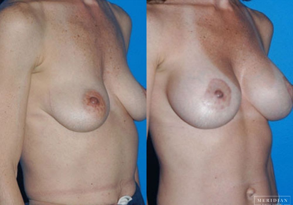 Body Contouring - Thumbnail 2