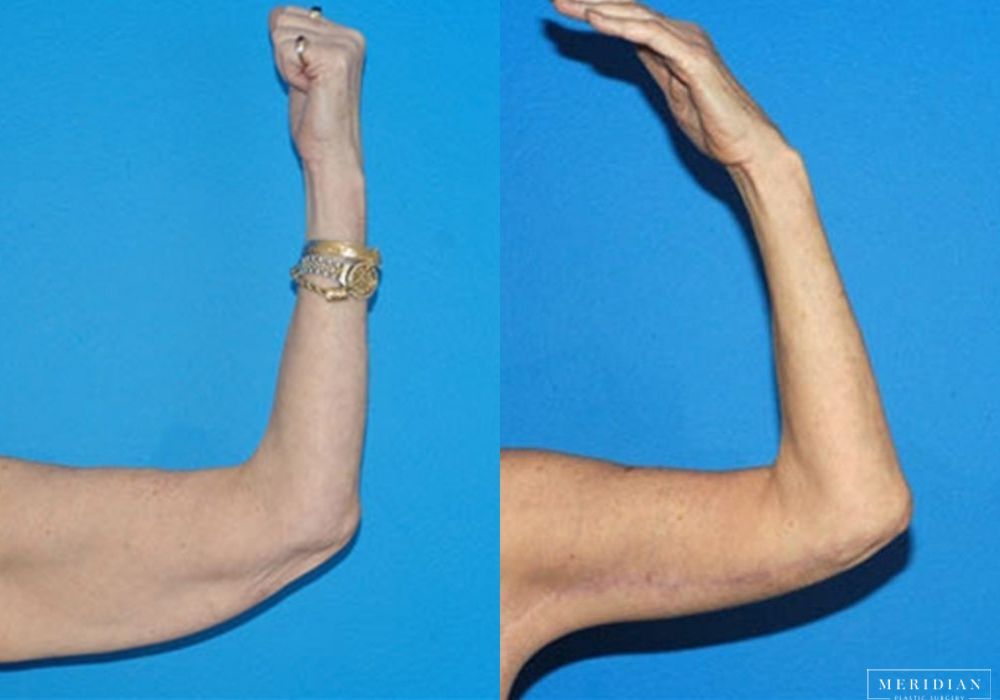 Arm Lift - Thumbnail 2