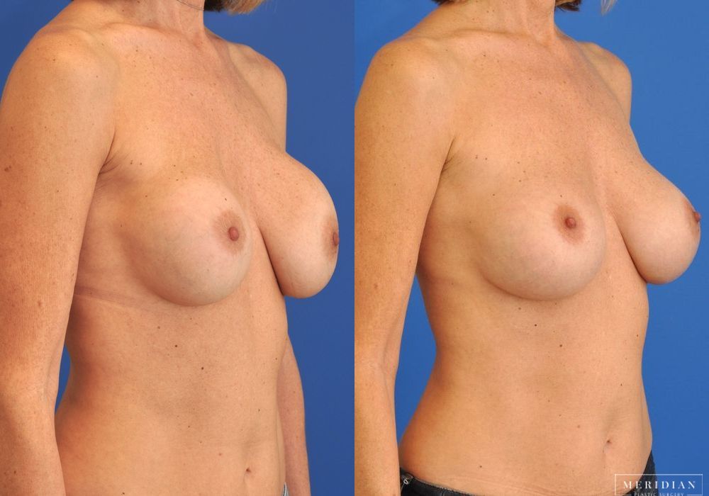 Breast Revision - Thumbnail 3