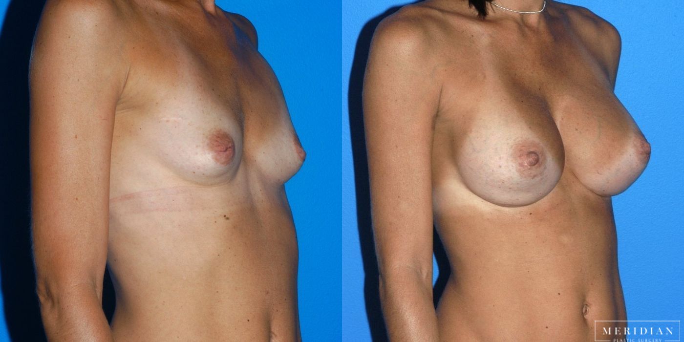 Breast Augmentation - Thumbnail 2
