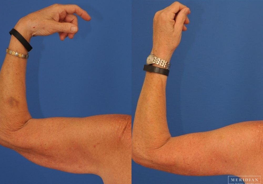 Arm Lift - Thumbnail 2